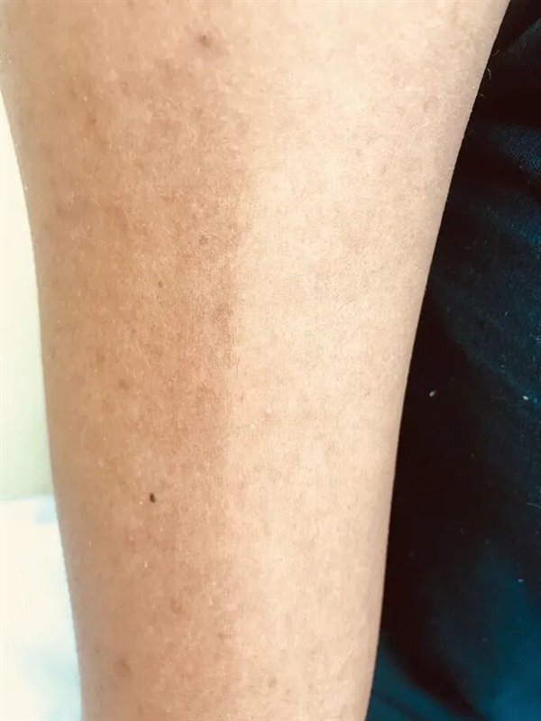 典型的色素性分界线。图片来自于参考资料