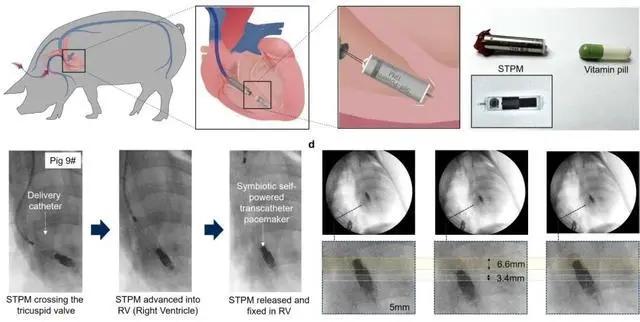 体内植入过程示意图与 DR 影像