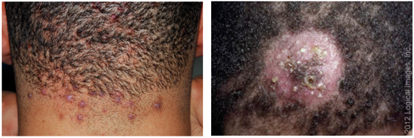 左图为头皮毛囊炎，右图为脓癣。图源：参考文献 