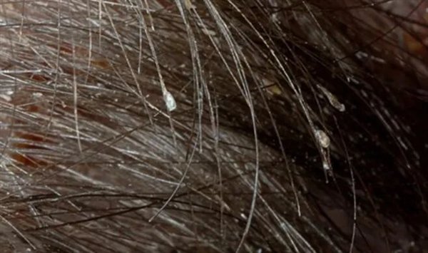 头虱病。图源：参考文献