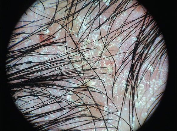 脂溢性皮炎皮肤镜表现。图源：参考文献