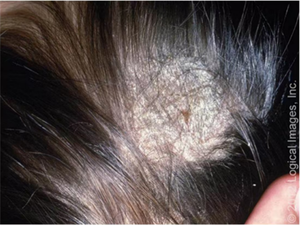 头癣。图源：参考文献