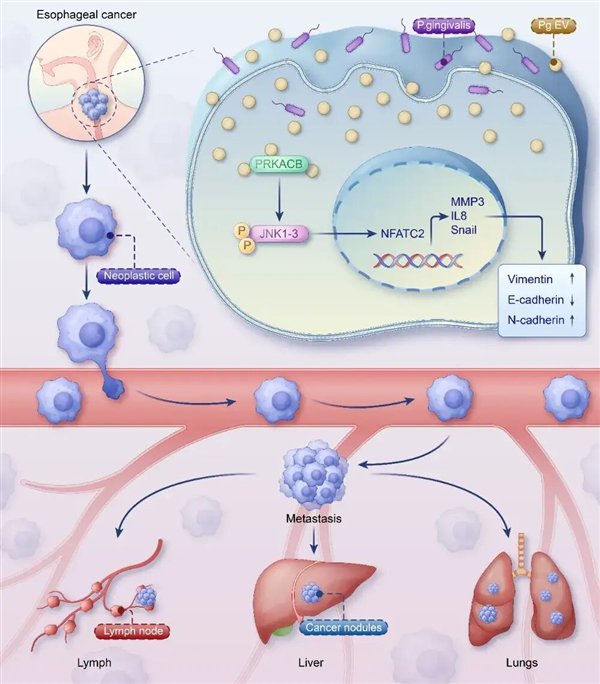 牙龈卟啉单胞菌胞外囊泡促进食管鳞癌进展的机制示意图 | 参考资料[1]