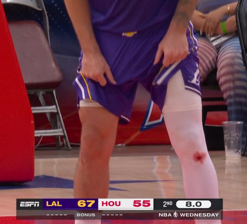 东契奇&库里膝盖出血之谜：不是药水 而是地板擦伤留下的真实血迹