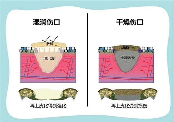 图2. 湿润伤口环境与干燥伤口环境在伤口愈合过程中的对比（来自参考资料）