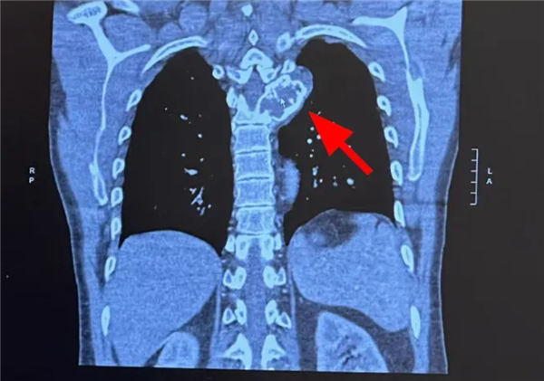 医生判死刑！亿万富翁靠AI逆转晚期癌症：疗效远超预期