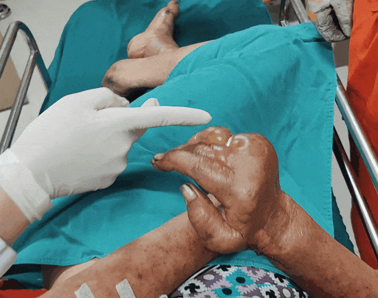 老人受伤的手。图源：广西消防 