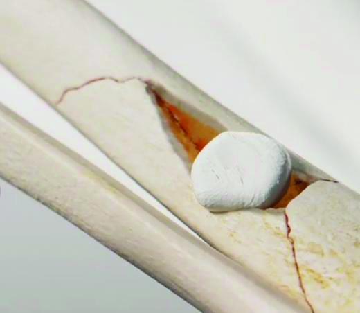 “女娲石”修复膝关节软骨缺损