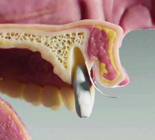 “女娲石”用于牙科、医美等领域