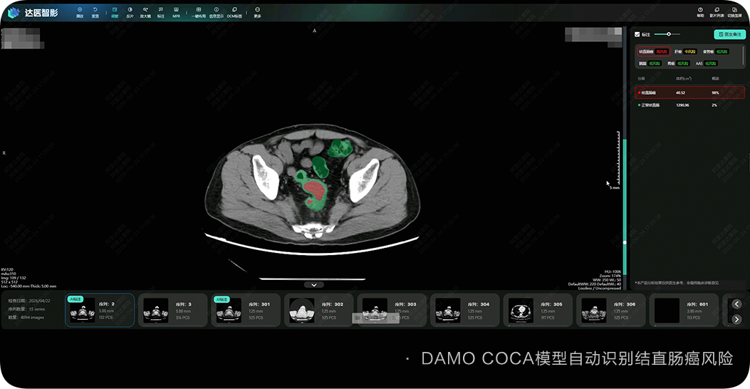 阿里达摩院 AI 全球首次实现肠癌“无感”检测，登上国际肿瘤学顶刊
