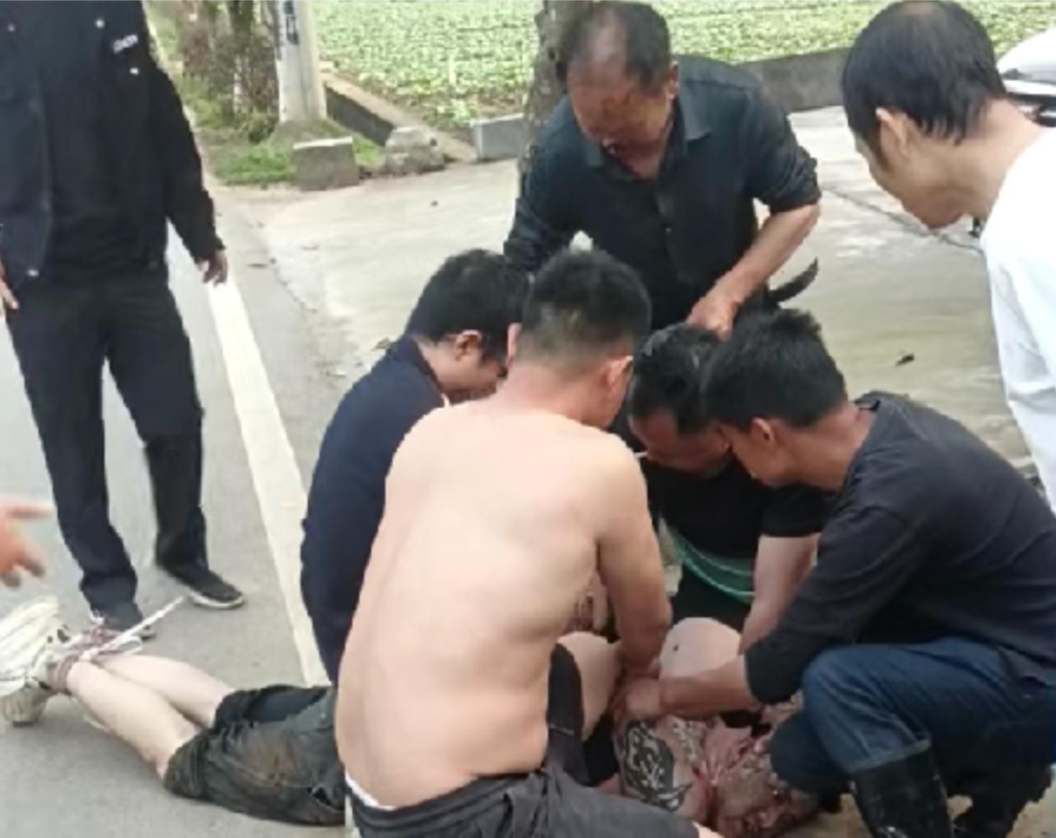 69岁老人勇斗歹徒被咬掉鼻子，已完成第一次手术今日将出院，本人：一开始不信自己鼻子没了，再遇到还会挺身而出