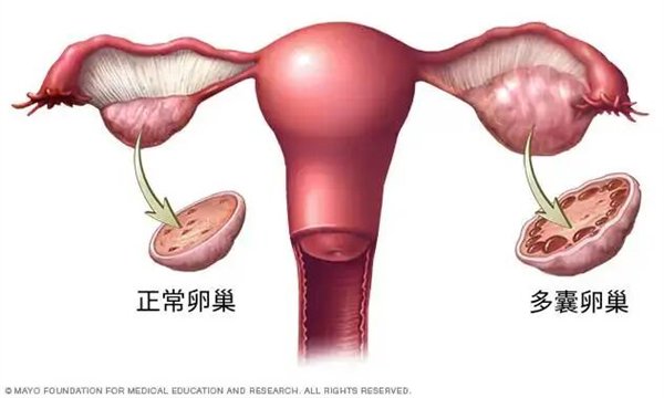 终于改名！这病困扰全球1.7亿女性 却被叫错90年