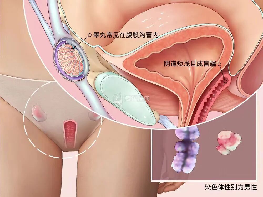 深圳26岁女子体检发现染色体为男性,患罕见完全性雄激素不敏感综合征