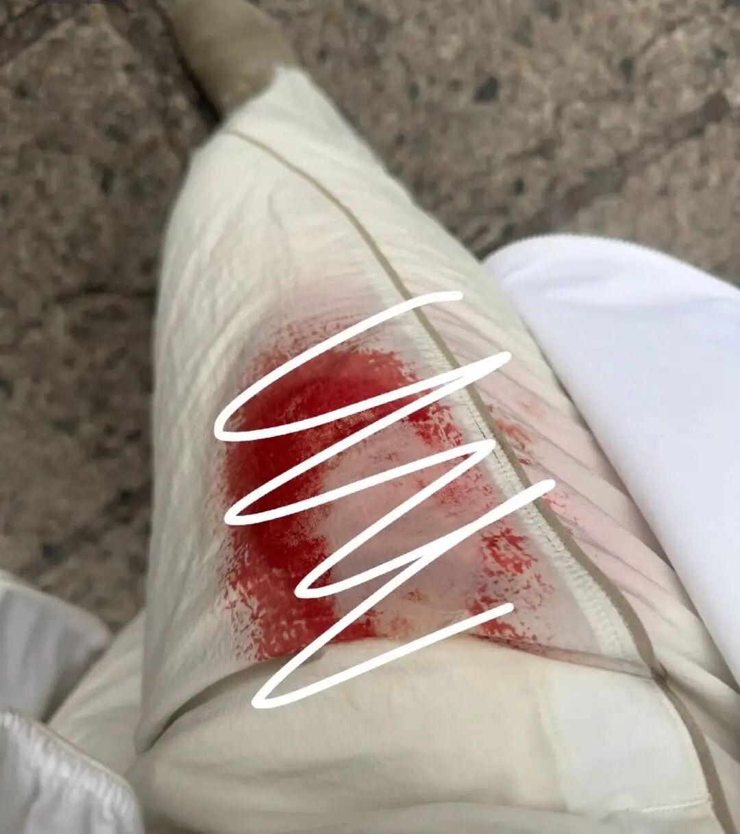 王女士大腿被抓咬出血