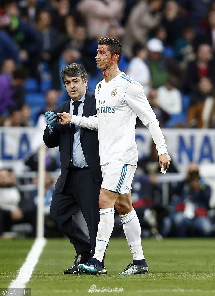 硬汉！C罗眉骨被踢破 一脸血