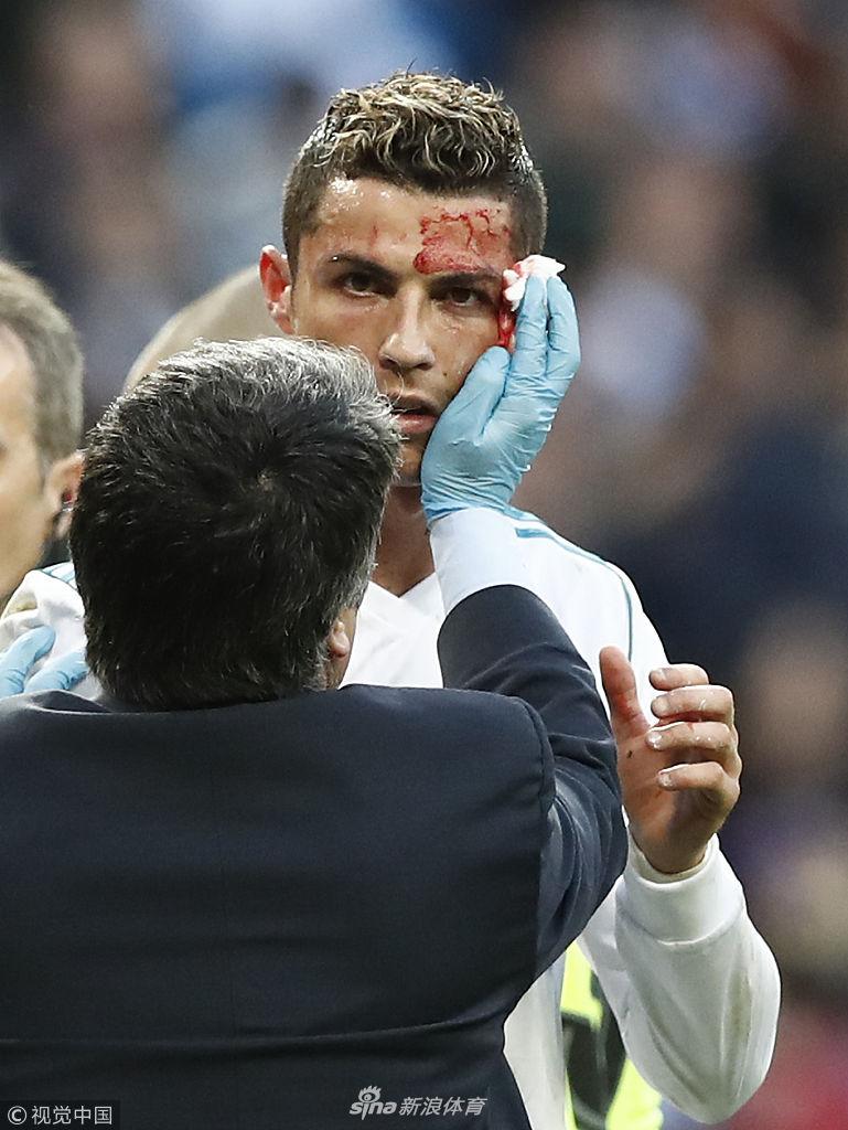 C罗血流不止