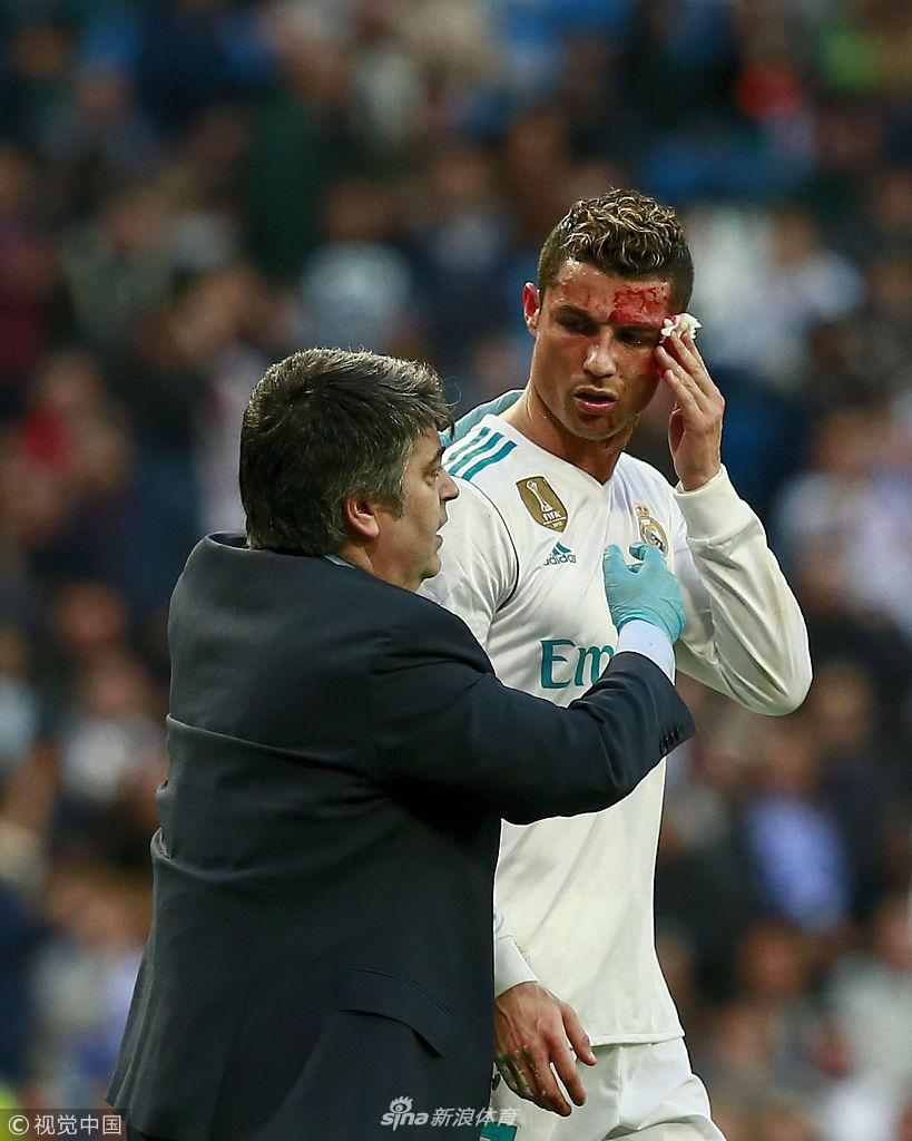 硬汉！C罗眉骨被踢破 一脸血