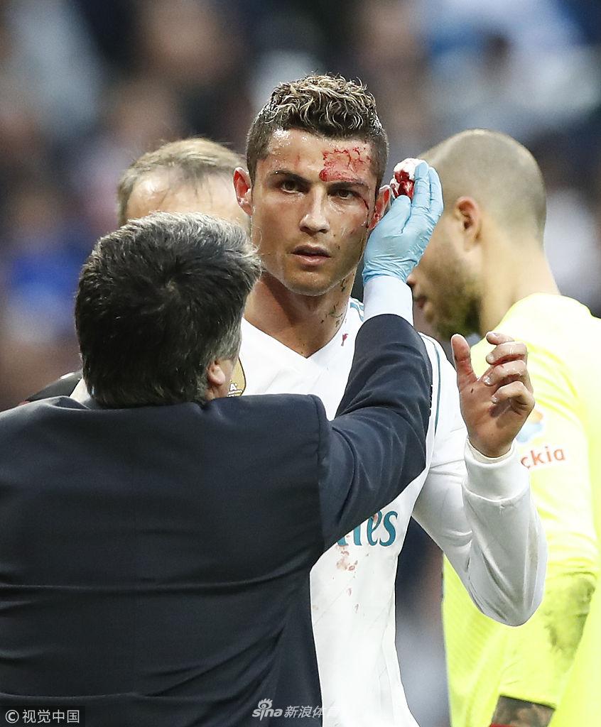 C罗一头都是血