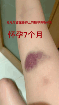 张培萌妻子晒遭家暴证据