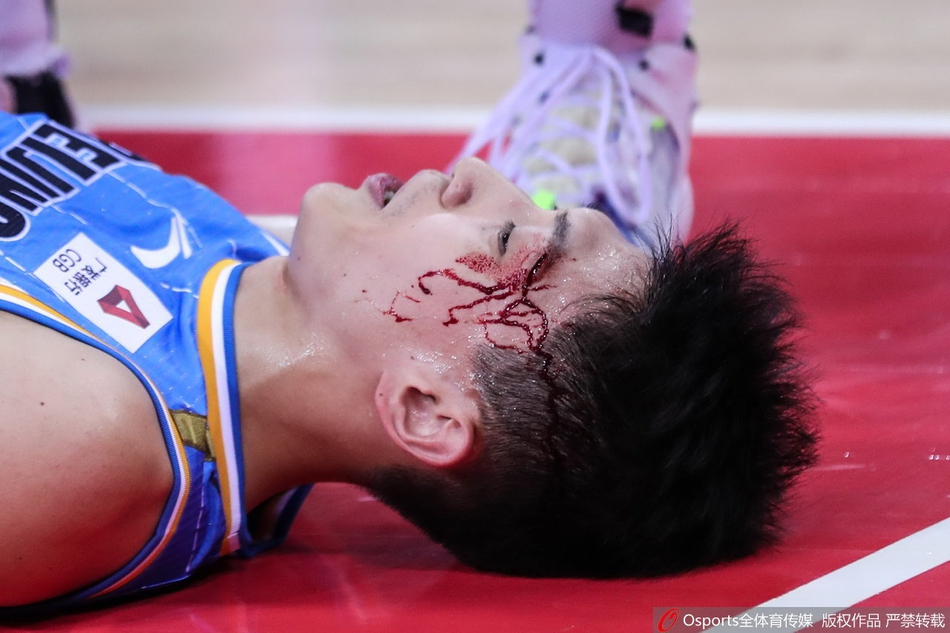 刘晓宇眉骨摔裂血流满面