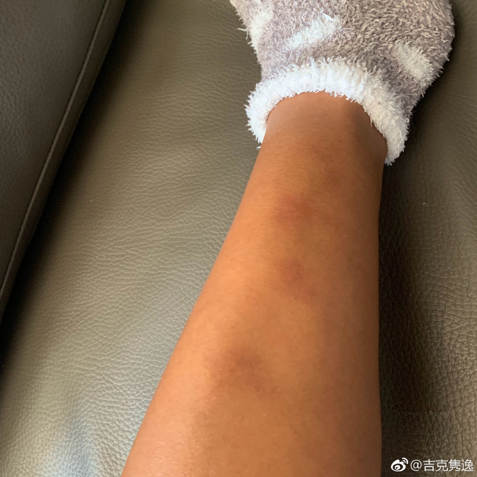 吉克隽逸练泰拳身体多处淤青