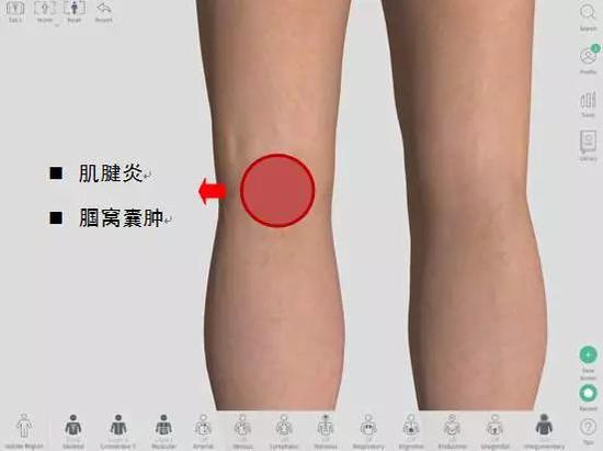 膝盖不同位置疼痛对应的可能病症 或与跑姿跑量