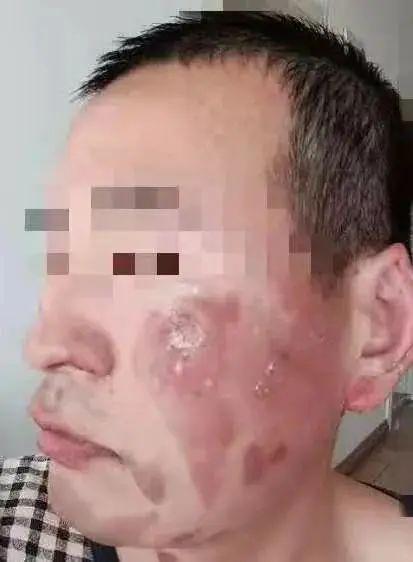 真冻脸!男子夜跑过后Ⅱ度冻伤 起水泡了