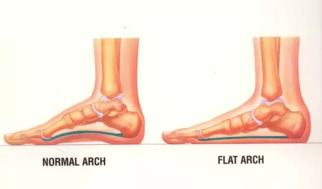 ▲ 左图是正常足弓，右图是扁平足足弓（足弓塌陷）