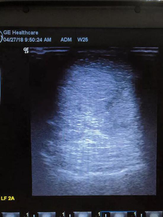 图7:副韧带炎慢性病例(1 年)横向扫描影像,b超显示损伤已愈合,但韧带