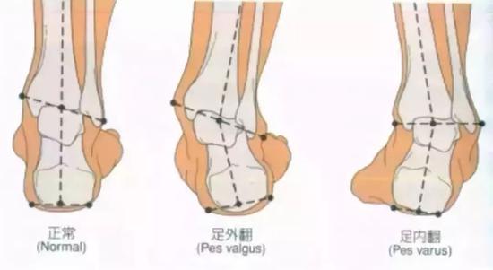当踝关节在跖屈(也就是做踮脚动作)时,往往脚会向内翻,即脚心翻向内.