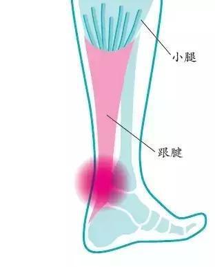 主要表现：足跟部上方及内部的疼痛、酸痛、压痛、僵硬，在活动后加剧。