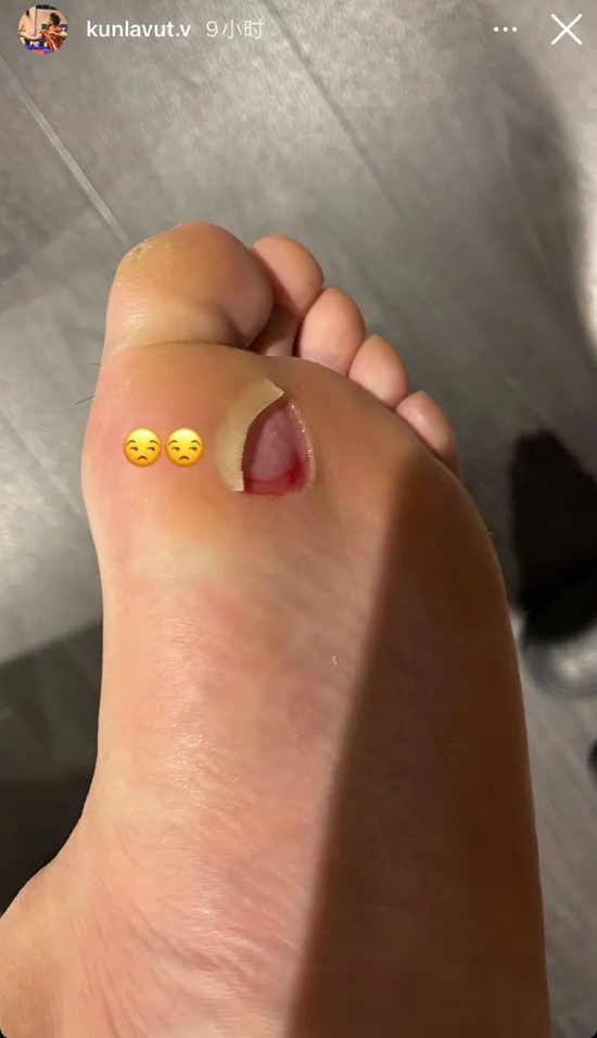  ¨全英>昆拉武特晒脚底被磨破血泡〖冠军〗 全英期待一黑到底 - 米尔