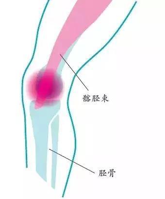 表现：膝盖外侧疼痛，在下楼或下山时疼痛加重。