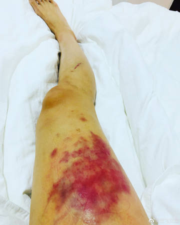 女足王飞发微博晒出自己腿部 伤痕累累不堪入目