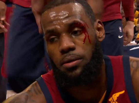 老詹激烈拼抢血染赛场