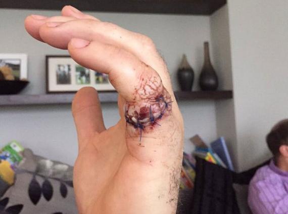 唐纳德森被锯子割伤惨不忍睹_手机新浪网