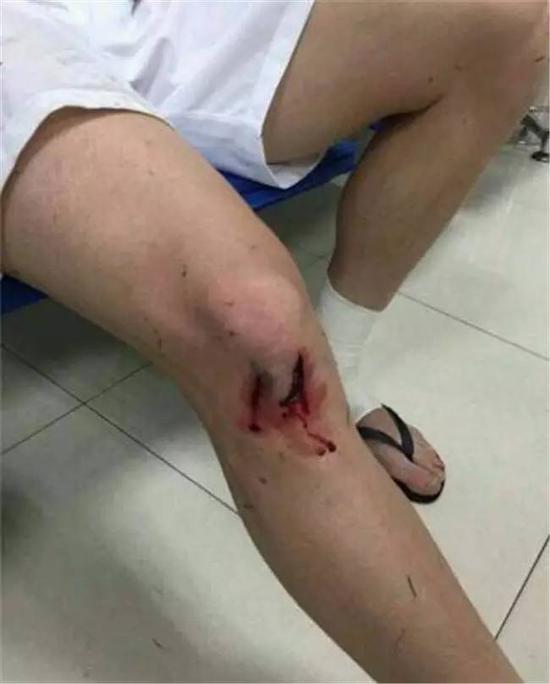 李建滨铲伤之人将缺阵三周膝盖伤口看着吓人图