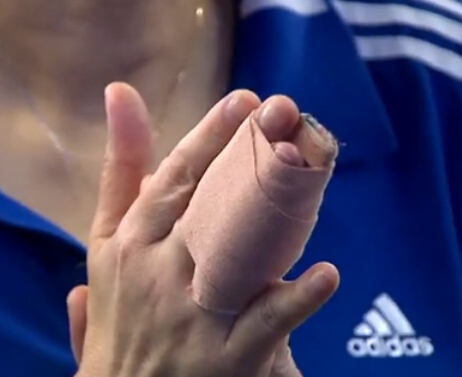 郎平意外受伤无名指脱臼