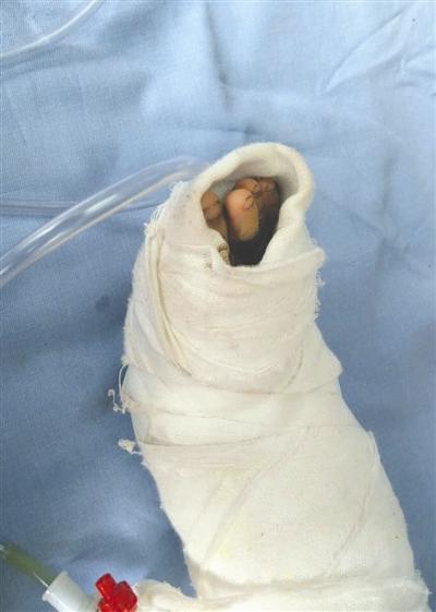 被烫伤的脚裹着纱布