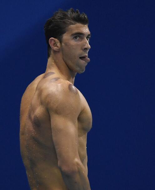 菲尔普斯身上的拔罐痕迹