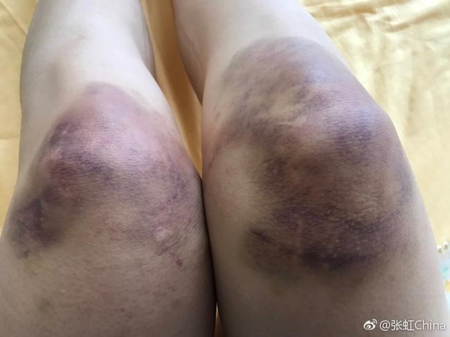 张虹晒自己双膝肿胀青紫的照片体坛 特约记者宏业报道 奥运冠军张虹在