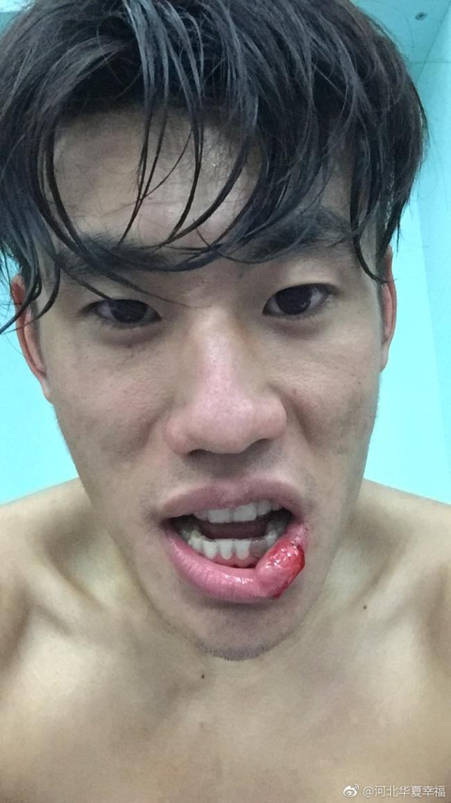 华夏赛后晒张呈栋嘴部伤势图 盛赞:血拼出的胜利