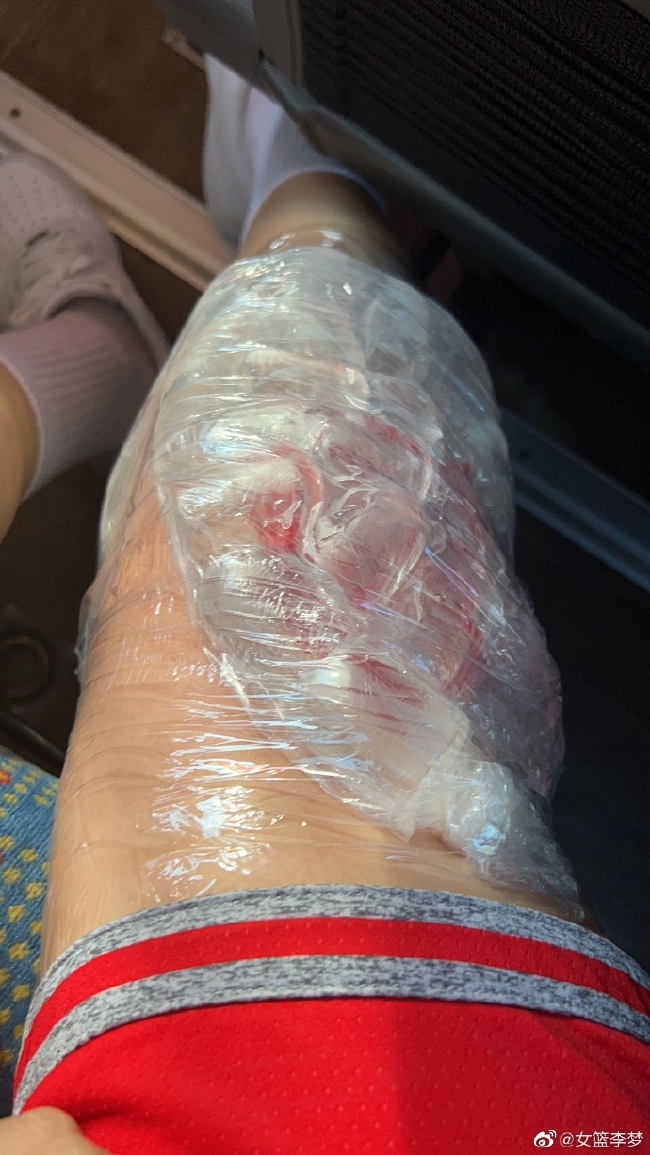 带伤出战!李梦晒膝盖冰敷照 两场9三分砍34分