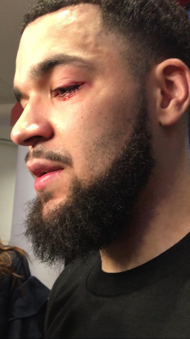 猛龙主力眼角出血要缝针[¨末段]!对他们是好事「眼角」?