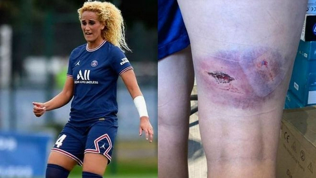 大巴黎女球员受伤图曝光 传前巴萨高层妻子雇人殴打！