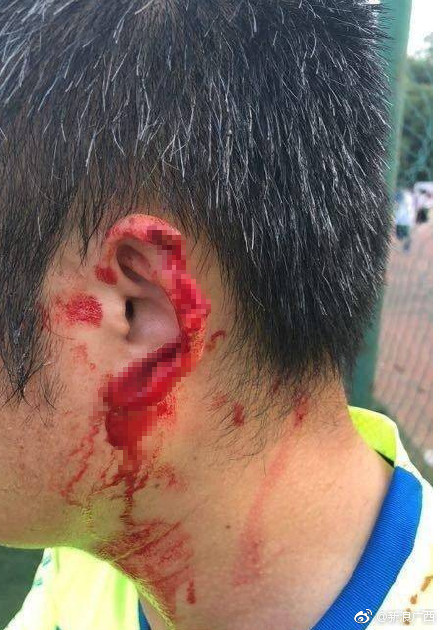 慎入南宁一足球比赛引发斗殴球员耳朵被咬烂