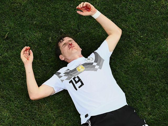 鲁迪遭踢脸骨折恐错过世界杯