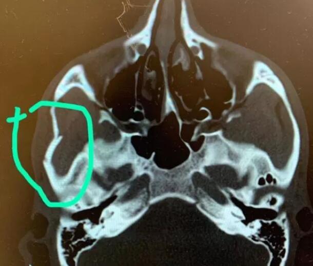 伊布一肘把对手脸部打骨折x光片看着太吓人