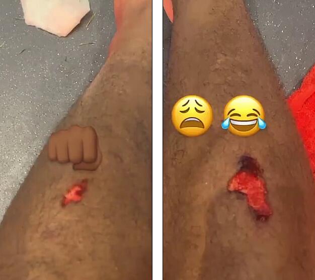 马夏尔拍照展示腿上伤情 皮开肉绽 有点触目惊心