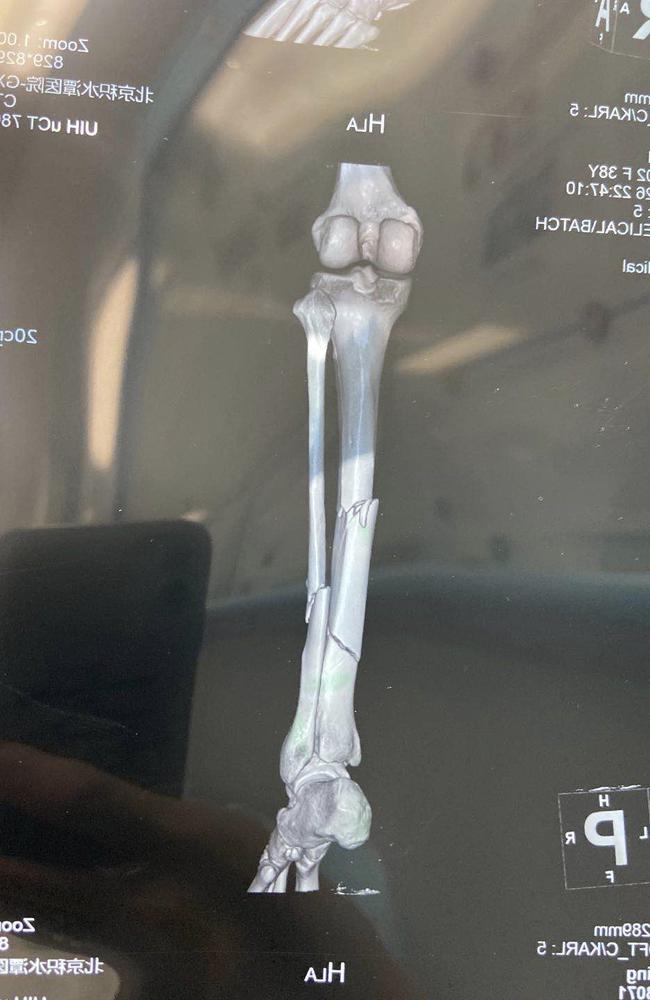 受害者右小腿胫骨骨折